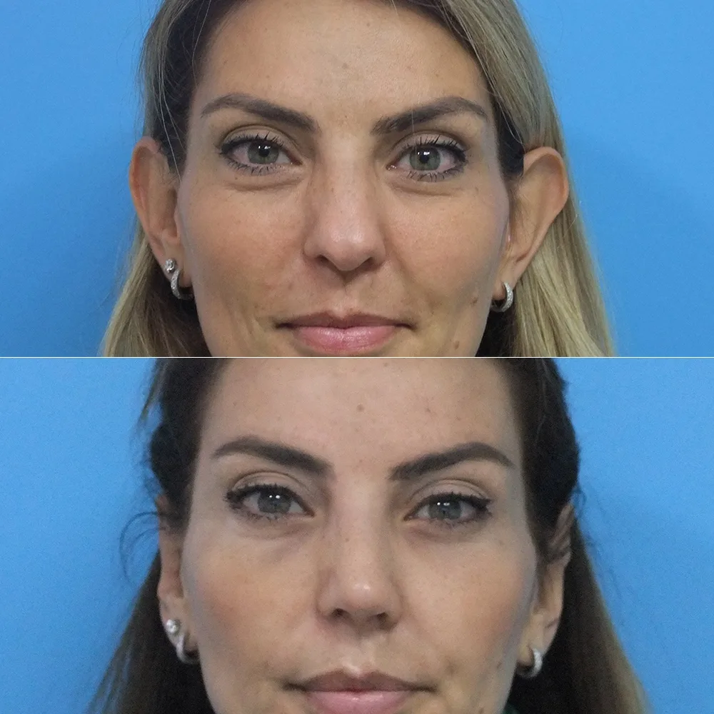 Case 04 — before and after