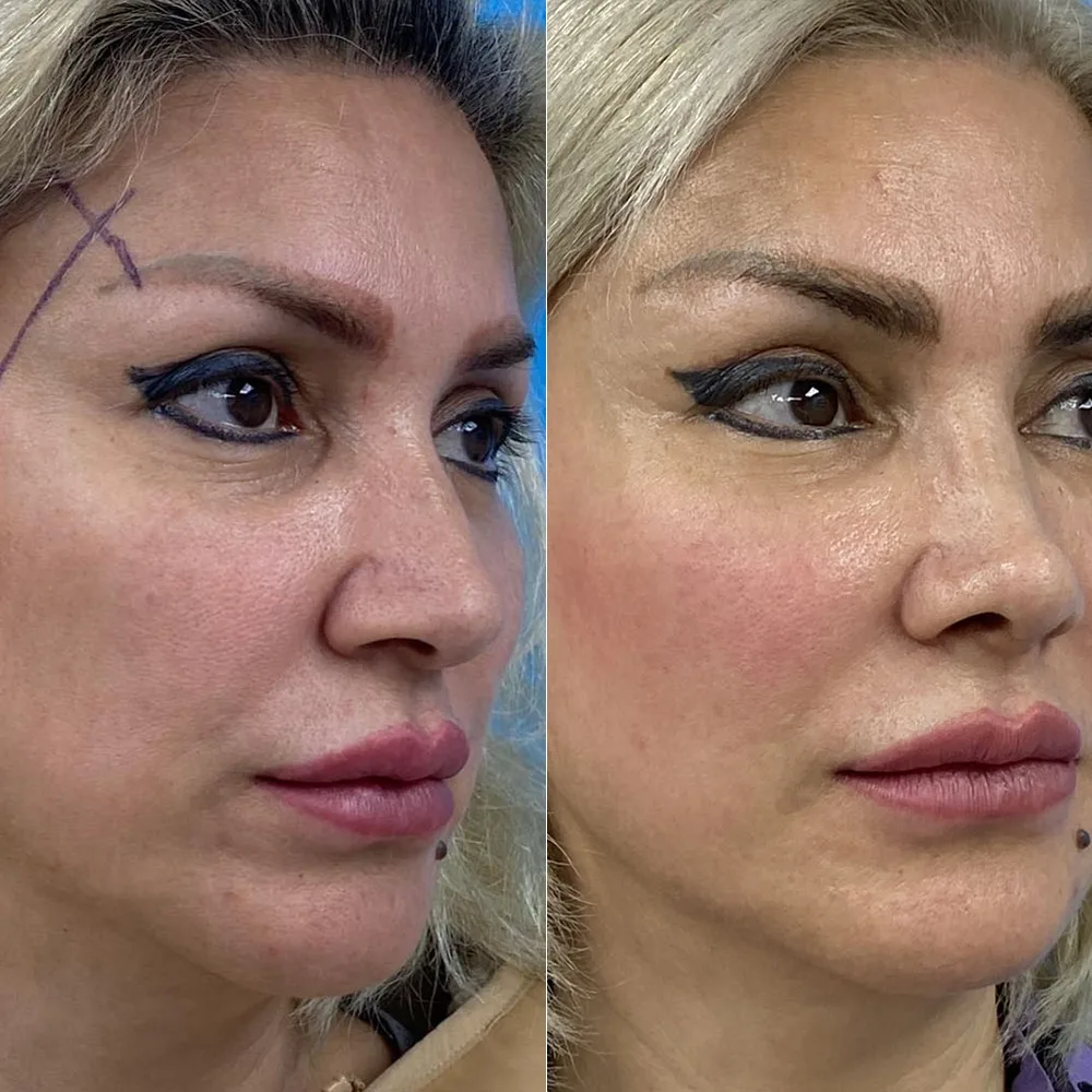 Case 04 — before and after
