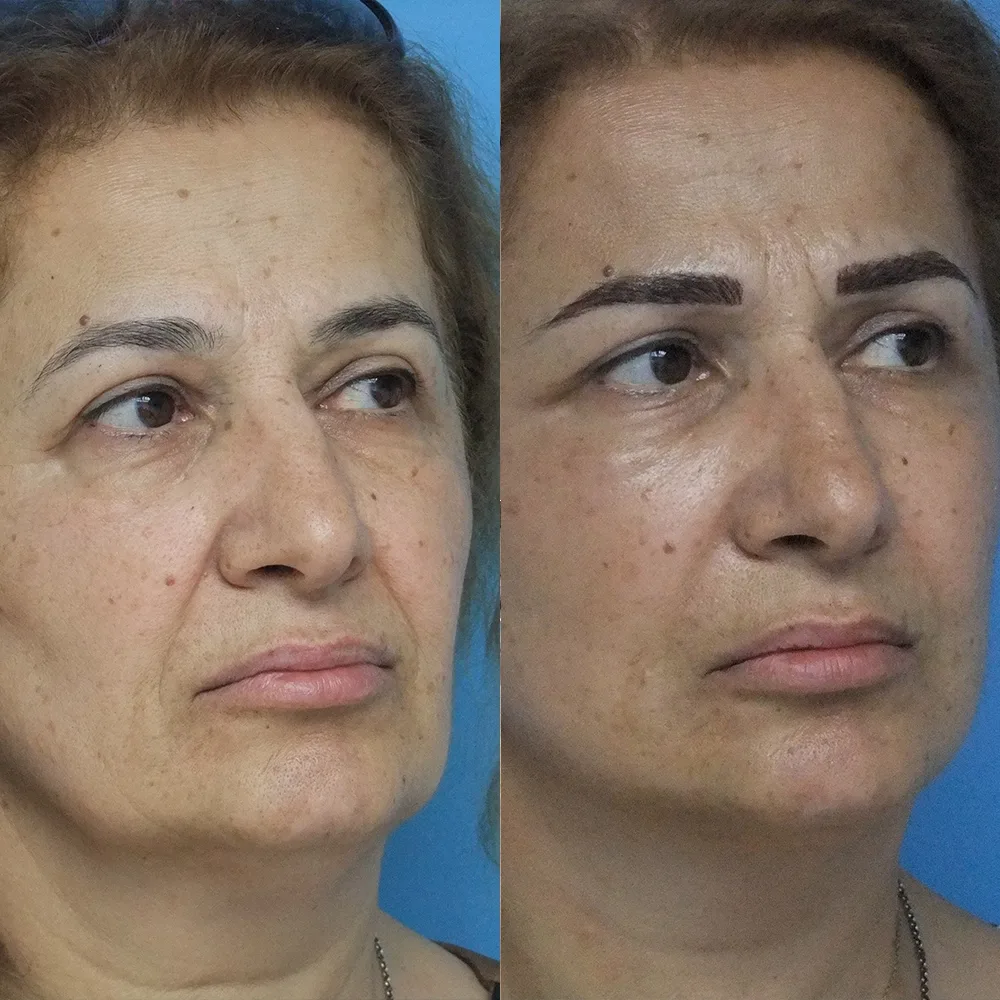 Case 09 — before and after