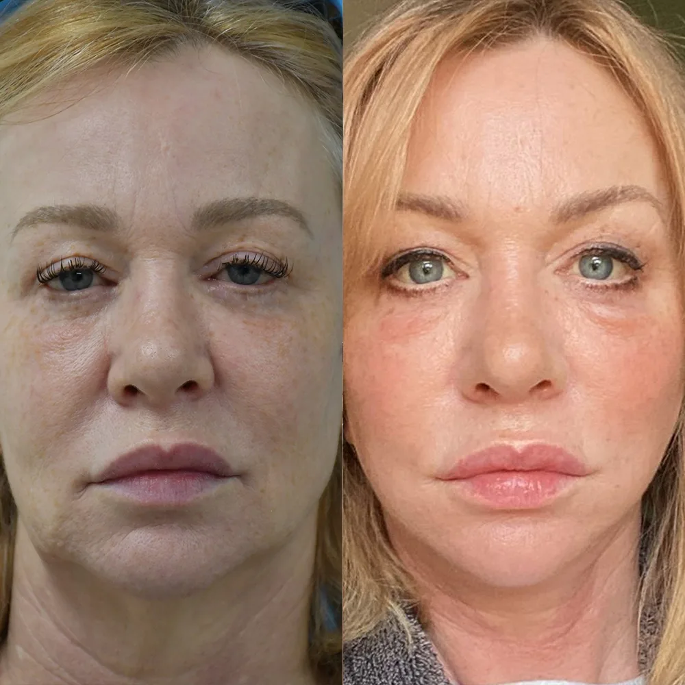 Case 10 — before and after