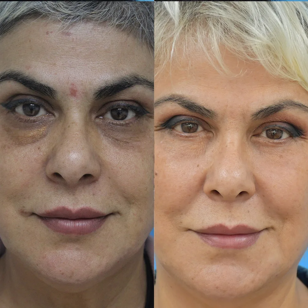 Case 04 — before and after
