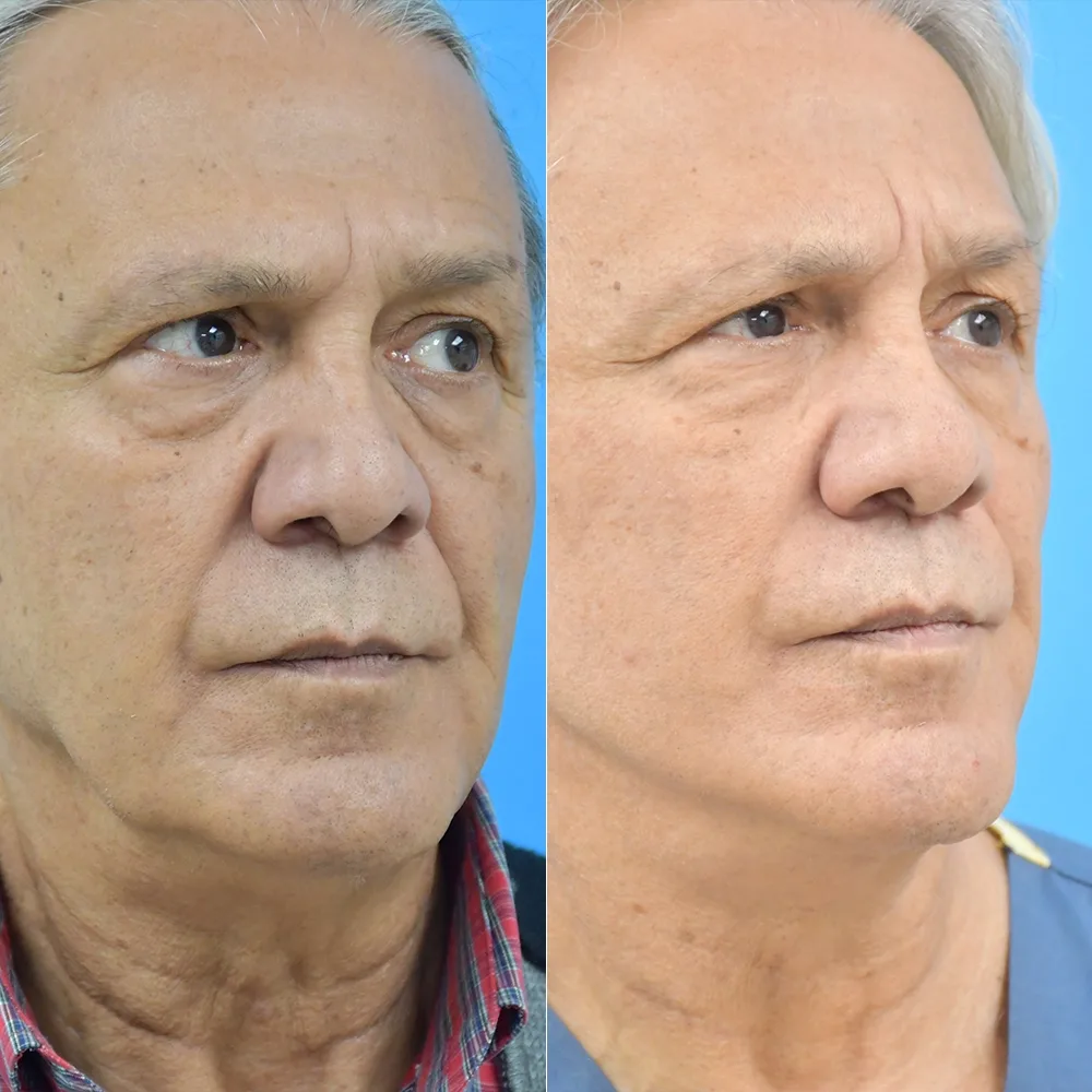 Case 11 — before and after