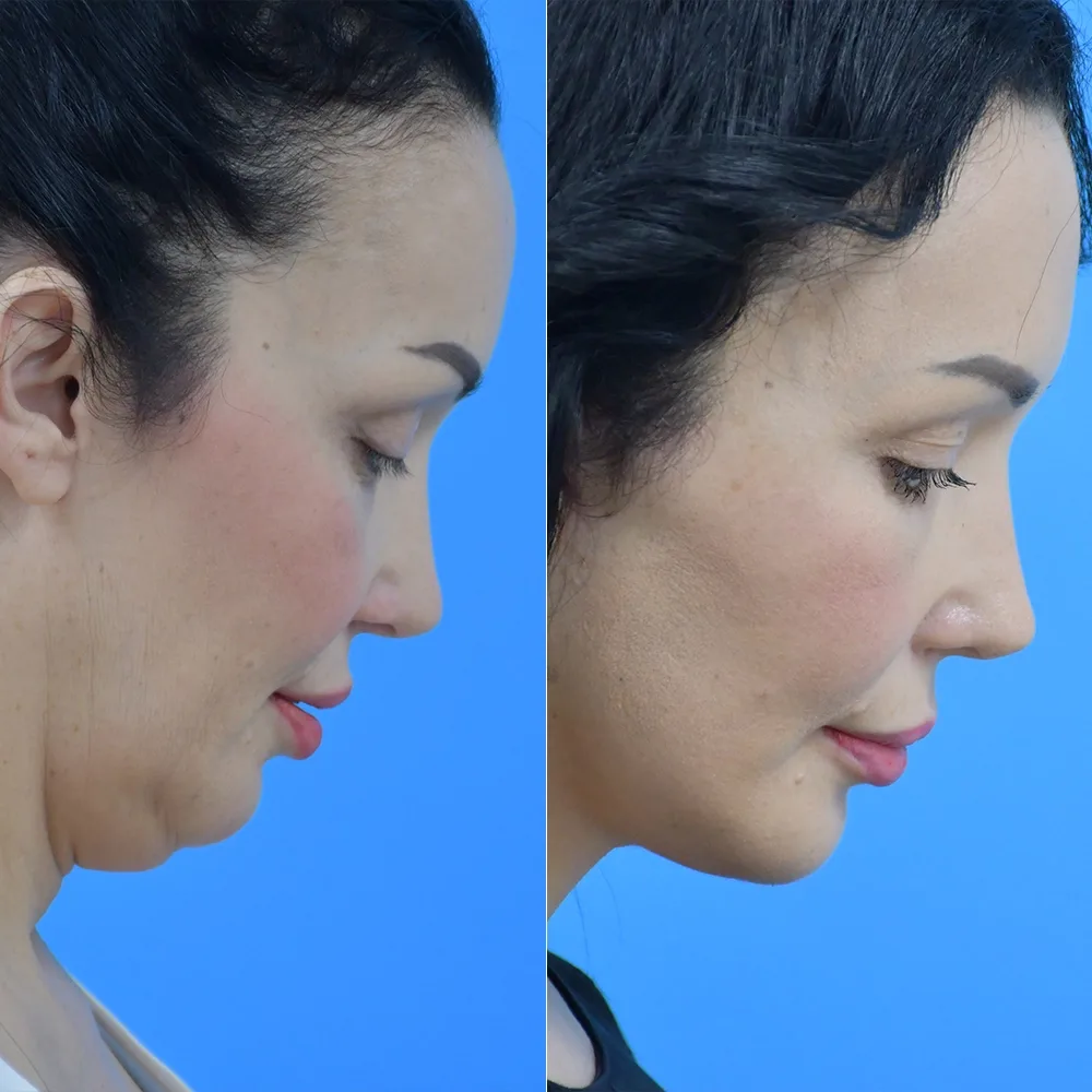 Case 14 — before and after
