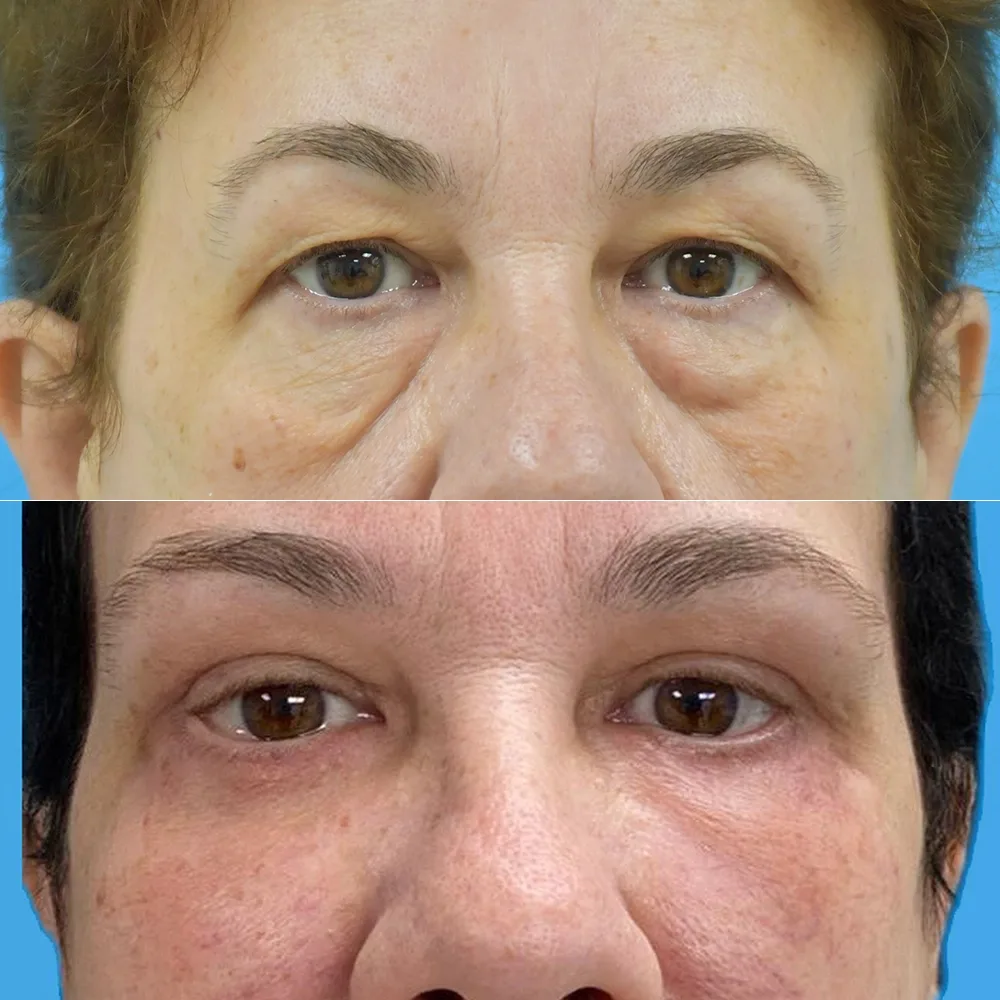 Case 13 — before and after