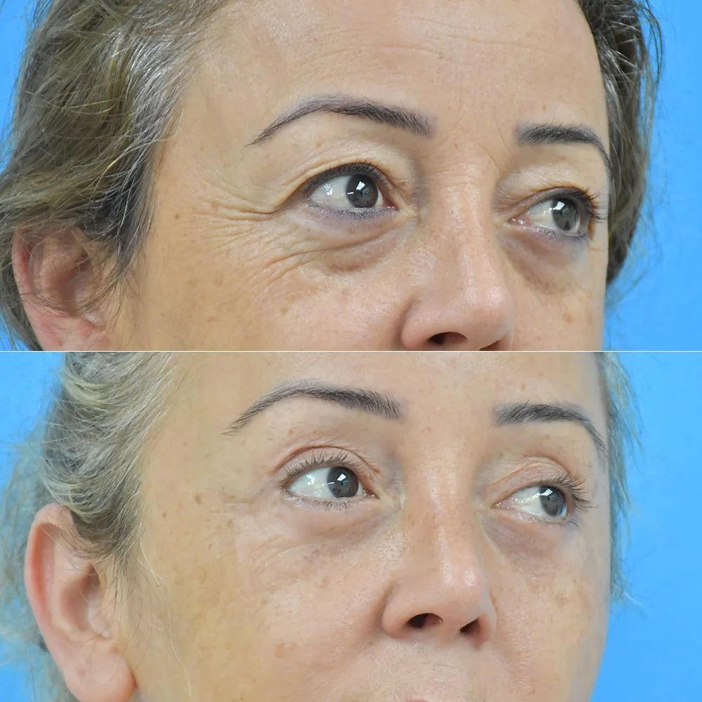 Case 11 — before and after