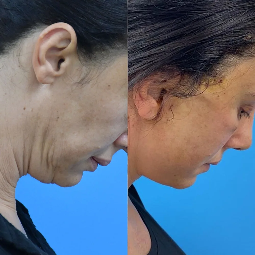 Case 13 — before and after