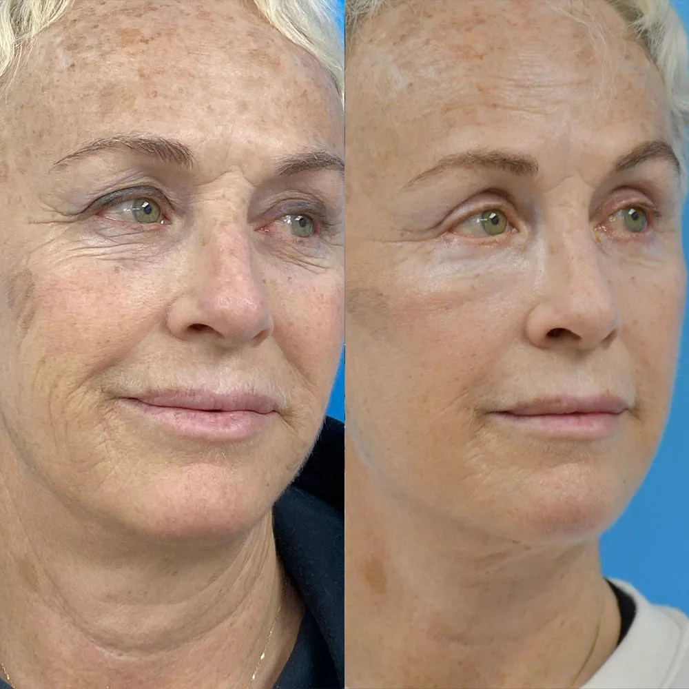 Case 04 — before and after