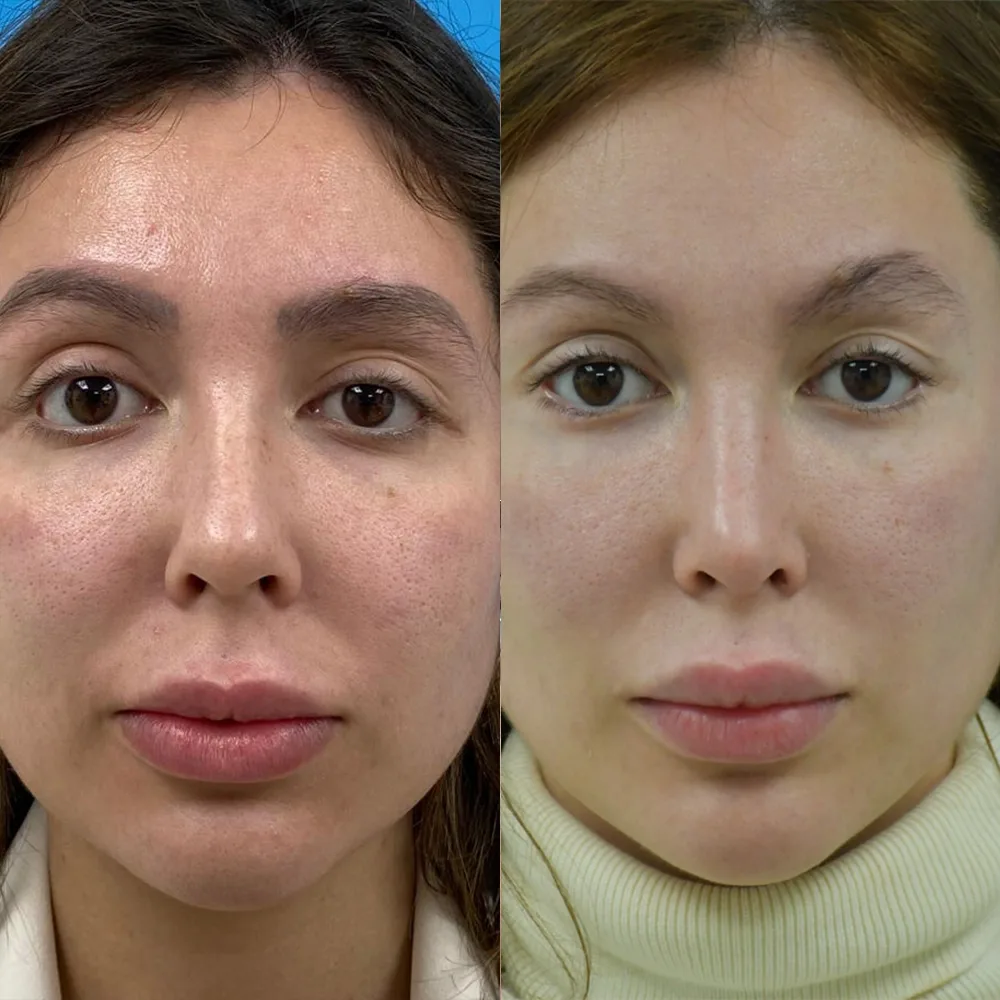 Case 05 — before and after
